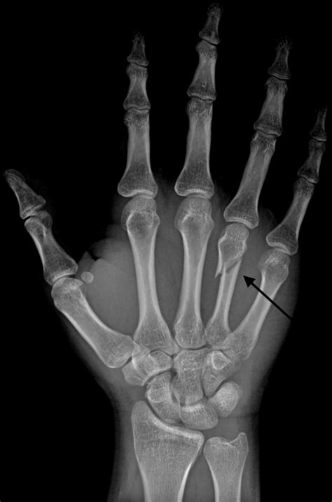 Boxers Fracture Wikem