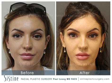 Jawline Slimming Before And After 04 Sistine Facial Plastic Surgery