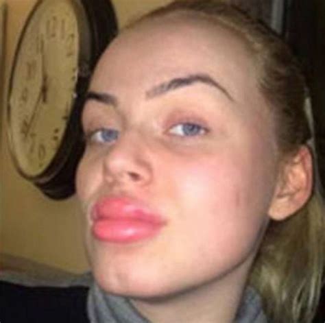Kylie Jenner Challenge Teens Are Using Bottle Tops To Get Kylie Jenner
