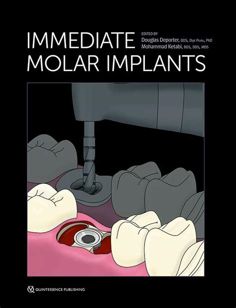 Immediate Molar Implants Quinted