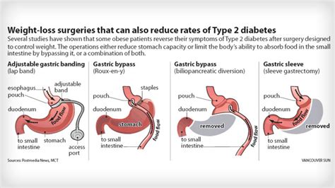Bariatric Surgery Could Tame Diabetes Doctor Tells