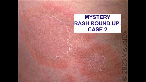 Another Mystery Rash Use The Skin Exam To Make A Diagnosis Youtube