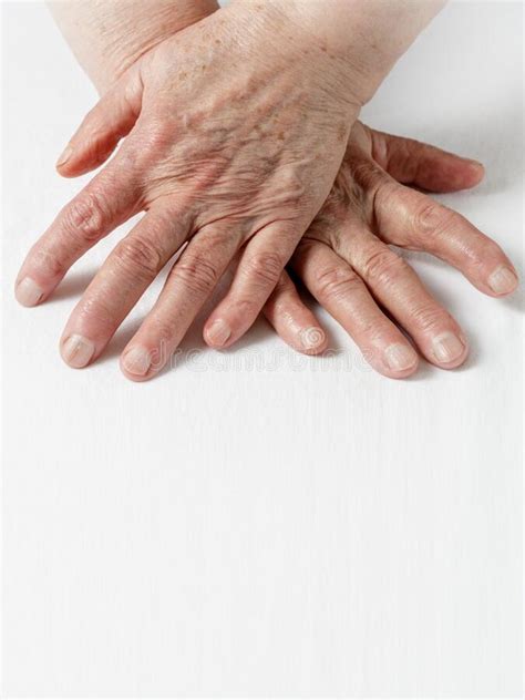 最も共有された！ √ Old Age Spots On Skin 194038 How Do I Get Rid Of Old Age