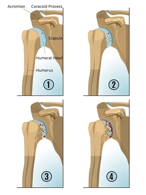 Rheumatoid Arthritis Shoulder