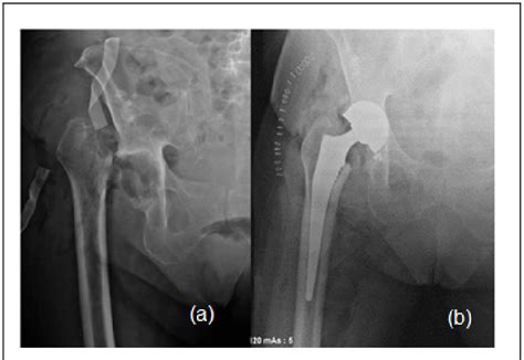 Final Postoperative Images A After Initial Resection Arthroplasty