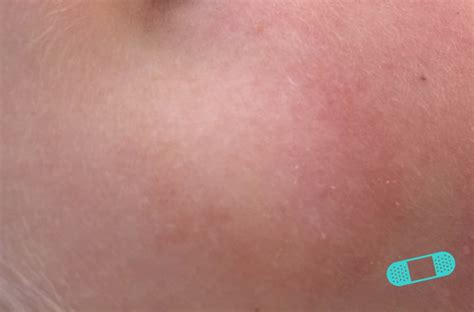 It must be remembered that discolored patches of pityriasis alba darken on prolonged exposure to sunlight. Hudläkare på nätet - Pityriasis alba