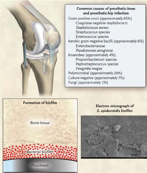 Causes Of Infection Associated With Prosthetic Joints There Are Two
