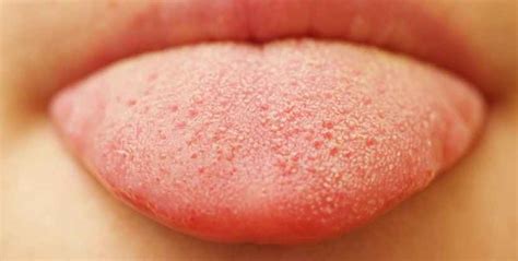 Hiv Bumps On Tongue