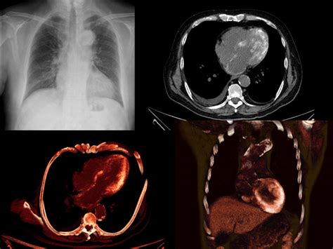 La forma más frecuente es la. Comunicación Cardiología clínica | Revista Española de ...