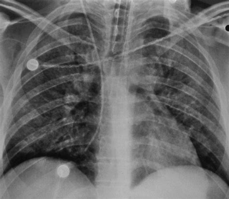 Clinical And Radiologic Features Of Pulmonary Edema Radiographics