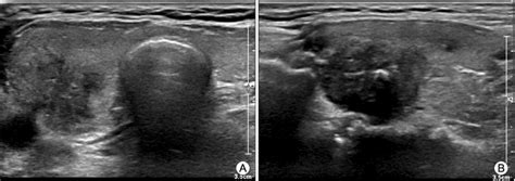 Transverse A And Axial B View Of Ultrasonogram Of Thyroid The