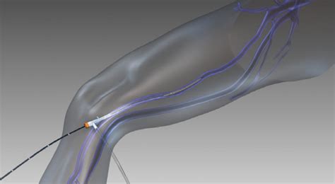 Radiofrequency Ablation Treatment For Varicose Veins