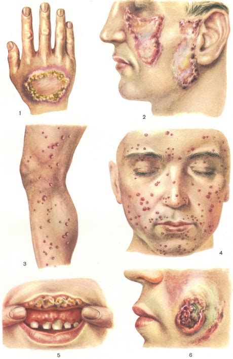 The tb skin test, also known as the mantoux tuberculin skin test, is the most common way doctors diagnose tuberculosis. Tuberculosis skin lupus infection forms of treatment