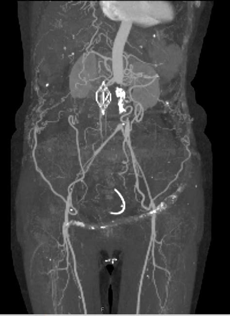 Aortic Occlusion With Collateral Flow Vascular Case Studies Ctisus