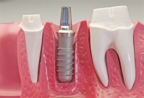 Dental Implants Glen Allen And Richmond Va Dental Care