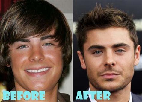 zac efron plastic surgery before and after nose job lovely surgery celebrity before and
