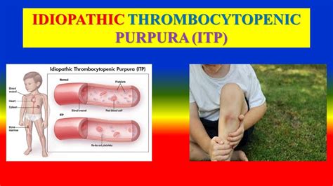 Idiopathic Thrombocytopenic Purpura Itp Definition Types