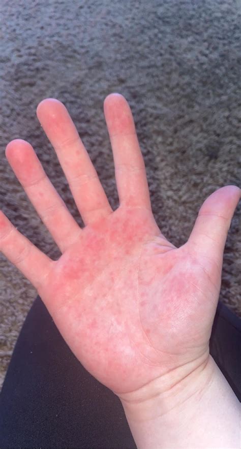 What Is This Weird Painless Rash On My Palms I Just Noticed It And Have No Idea What It Could
