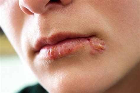 Herpes Im Mund Auslöser Und Behandlung Heilpraxis