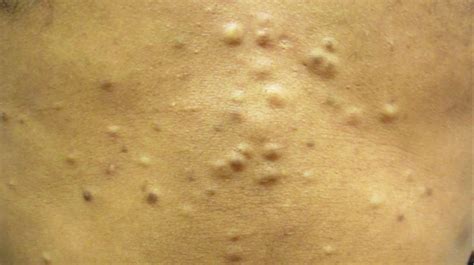 30 Year Old Male With Asymptomatic Lesions On Abdomen The Doctors