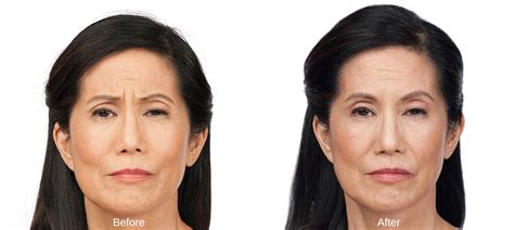 Botox Treatment In Teaneck Nj Call Vanity Medical Spa Now