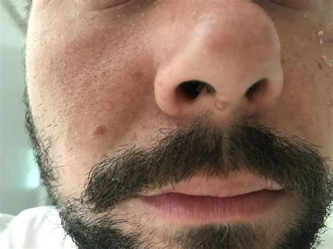Little Growth On Bottom Of Nose Started Much Smaller And Slowly Has