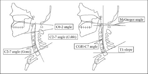 Pdf Evaluating Cervical Sagittal Alignment In Cervical Myelopathy