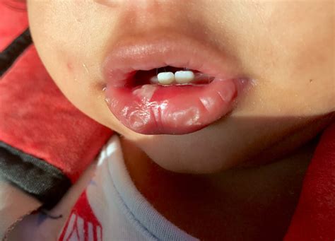 Causes And Treatment Of A Baby Canker Sore