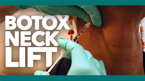 Botox Neck Lift Botox For Neck Bands And Platysma Muscles Los Angeles