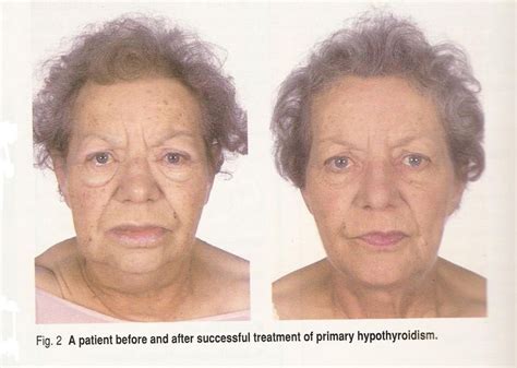Hypothyroidism Face Before And After Want To Know More Click On The