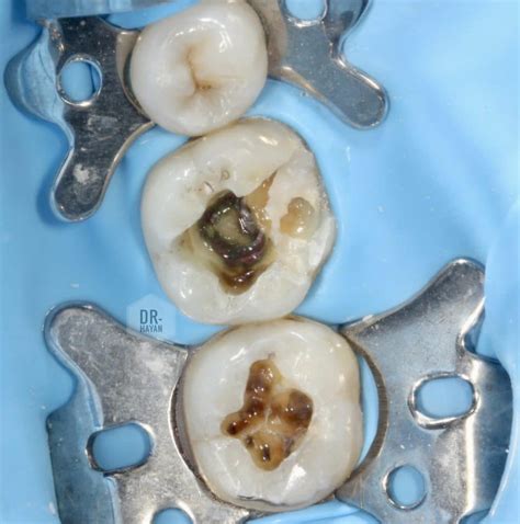 Re Operative Lower Molar Teeth Step By Step Myzerodonto