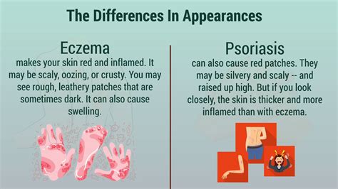 Psoriasis Vs Eczema Youtube