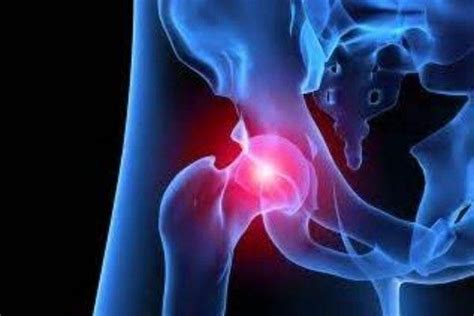 4 Things You Need To Know When Youre Having A Total Hip Replacement