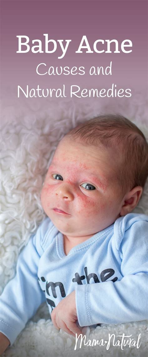 Baby Acne What Causes It And How To Treat Naturally