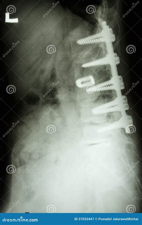 Lumbar Spine With Pedicle Fixation Stock Image Image Of Health