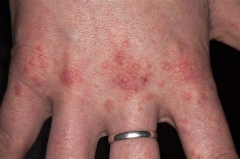 Skin Manifestations Of Chronic Hepatitis C Virus Infection Dermatology Advisor