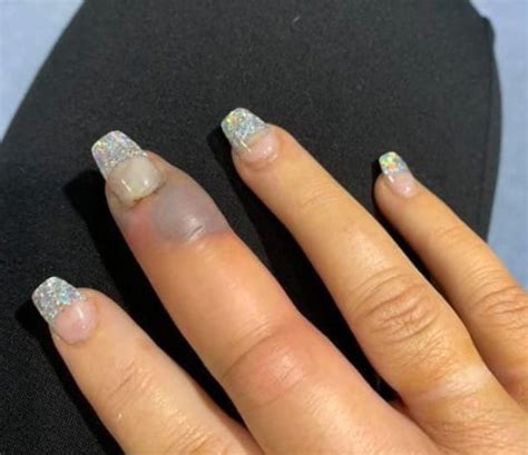 Womans Finger Swelled And Turned Black After Getting A Salon Manicure