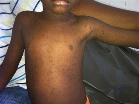 Image Of The Week Erythematous Rash And Fever Clinical Advisor