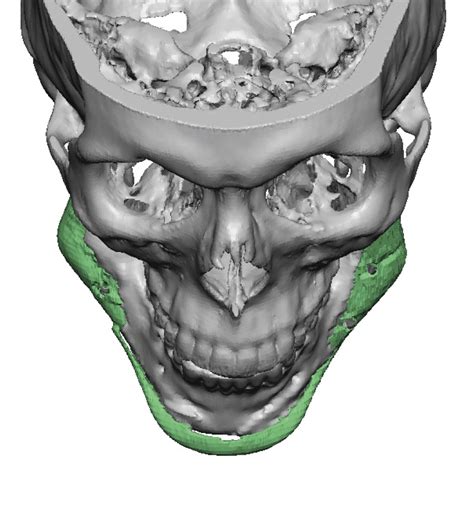 Standard Chin And Jaw Angle Implants 3d Ct Scan Top View Dr Barry