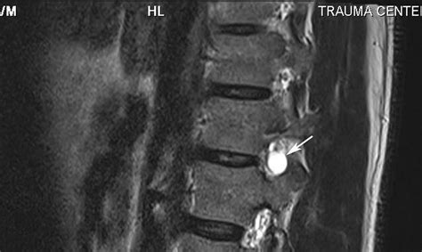 Radiodiagnosis Imaging Is Amazing Interesting Cases Tarlov Cyst