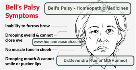 Although the exact reason bell's palsy occurs isn't clear, it's often related to having a viral infection. Bell's Palsy Homeopathic Medicines -Top 6 for quick recovery
