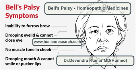 Most people make a full recovery within 9 months, but it. Bell's Palsy Homeopathic Medicines -Top 6 for quick recovery