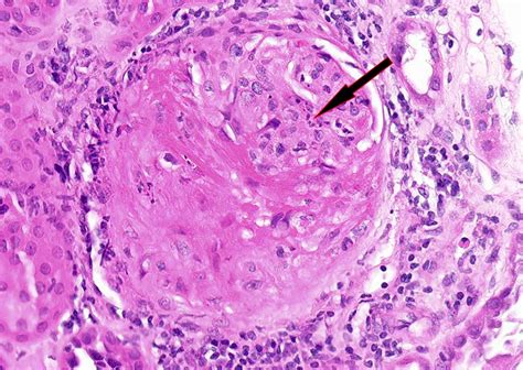 Pathology Outlines Granulomatosis With Polyangiitis
