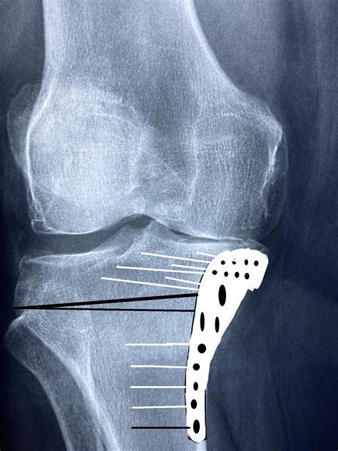 High Tibial Osteotomy Orthopedics Notes