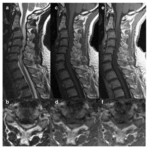Mri Images Of A 53 Year Old Man With Spinal Cord Edema Due To Cervical