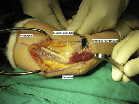 Intraoperative Photograph Shows Compression Of The Ulnar Nerve By The