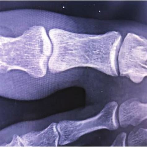 Pdf Avulsion Fracture In Distal Phalanx Of Left Great Toe A Rare