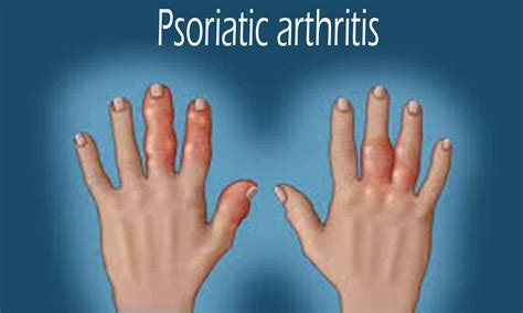 Eular Updates Management Recommendations For Psoriatic Arthritis