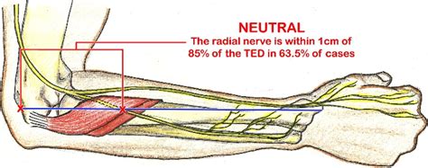 Radial Nerve Entrapment
