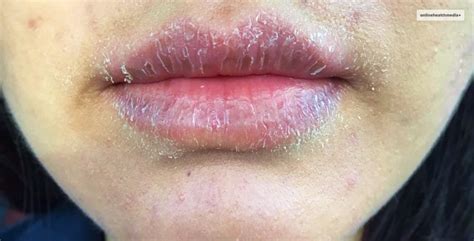 Eczema On Lips Types Causes Symptoms Treatment And More